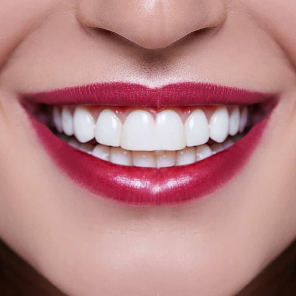 Whitening-Teeth After