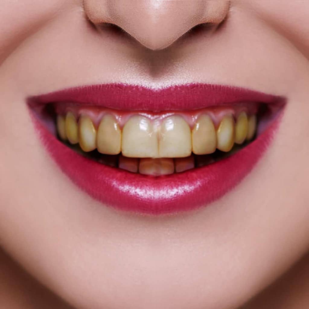 Whitening-Teeth Before