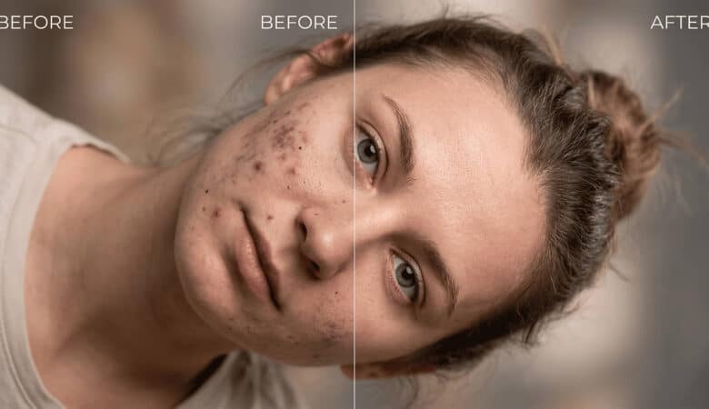 How To Remove Black Spots from Face in Photoshop (Without Losing Texture)