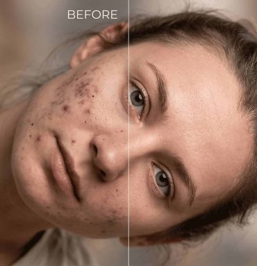 How To Remove Black Spots from Face in Photoshop (Without Losing Texture)
